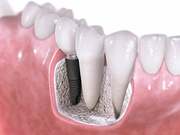 What Is Gum Disease.