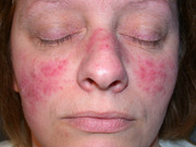 Proven Treatment Option for Acne and Rosacea Treatment in Wollongong