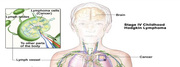 How to start process for my Lymphoma treatment in India?