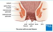 anal fissure treatment