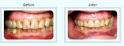 Porcelain Crowns and Veneers Treatment by Healthy Smiles 