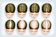 Expert Treatment for Female Hair Loss