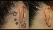 Laser Tattoo Removal Melbourne Services