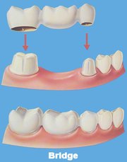 Best Dental Implants Service in Richmond