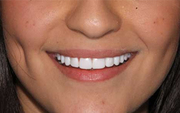 Dental Implants Sydney - Orthodontist in Sydney CBD