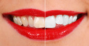 Achieve Stunning Look by Teeth Whitening