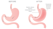 Find Gastric Sleeve Surgery Specialist in Perth,  Australia