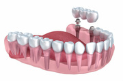 Cosmetic Dental Implants Dentistry in Sydney