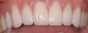 Best Porcelain Veneers Melbourne - Captivate Dental