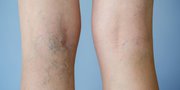 Long-Term Relief Spider Vein Treatment in Melbourne