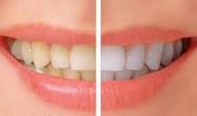 Tooth Whitening – BEDC