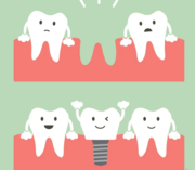 Tooth Implants Cost in Arana Hills- My Gentle Dentist