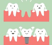 Dental Implants - Cost of Dental Implants