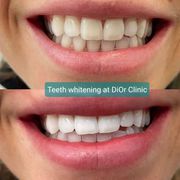 Get Your Brightest Smile with LED Teeth Whitening Treatment in Pascoe 