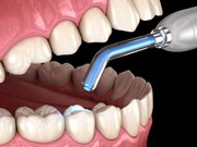 Teeth Whitening Warrawee | Brighter Smiles at St Ives Family Dental